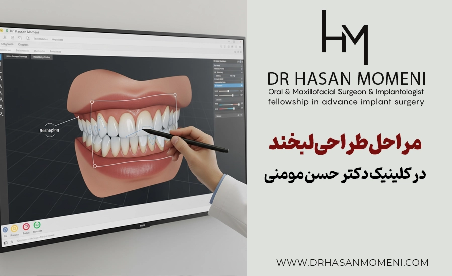 مراحل طراحی لبخند در اصفهان کلینیک دکتر حسن مومنی
