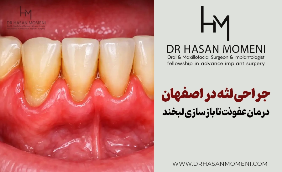 جراحی لثه در اصفهان: از درمان عفونت تا بازسازی لبخند