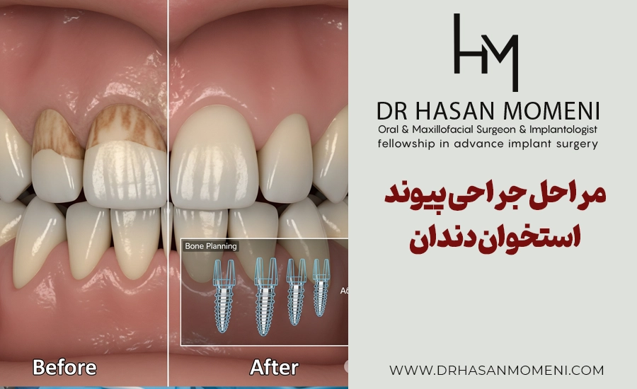 مراحل جراحی پیوند استخوان دندان