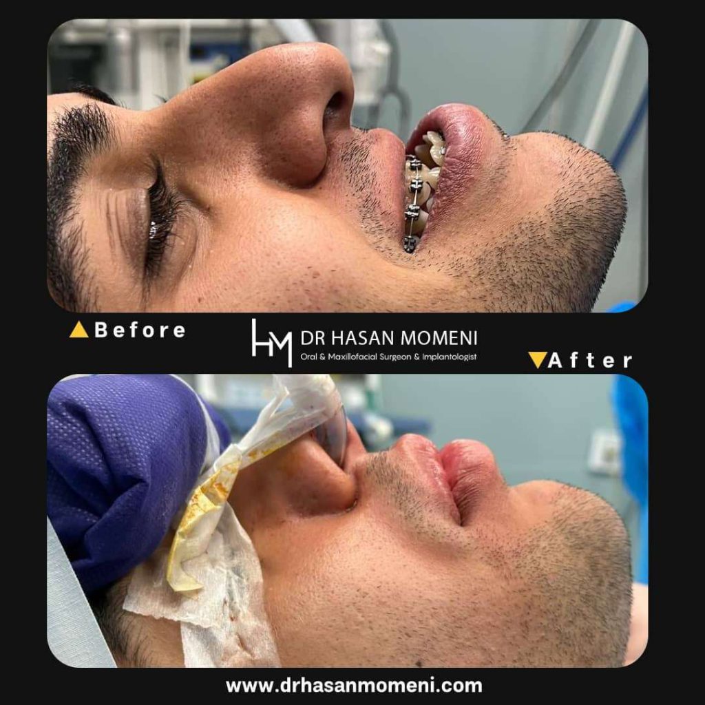 نمونه عکس جراحی فک برای برای بیمار فولادشهر در کلینیک دکتر حسن مومنی