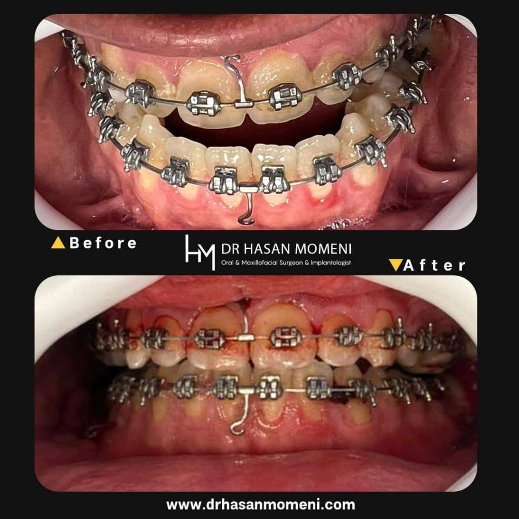 نمونه عکس جراحی فک برای برای بیمار فولادشهر در کلینیک دکتر حسن مومنی