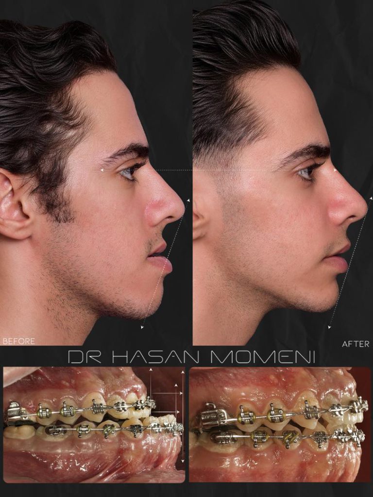 جراحی فک بالا و پایین کلاس ۳ برای بیمار عزیز از بهارستان؛ اصلاح جلو بودن فک و ناهنجاری فکی