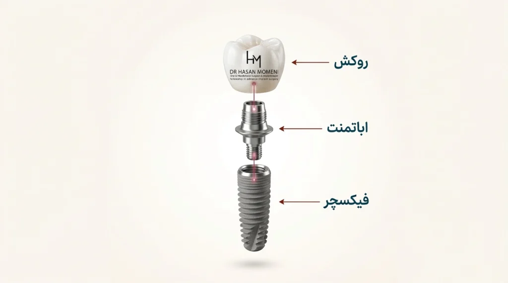 آناتومی یک ایمپلنت