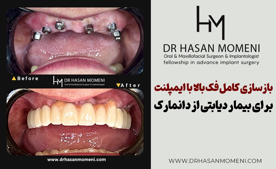 بازسازی کامل فک بالا با ایمپلنت برای بیمار دیابتی از دانمارک توسط دکتر حسن مومنی در اصفهان