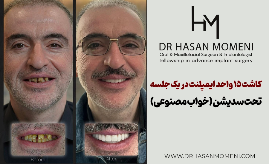 درمان بیمار اصفهانی با بازسازی کامل دهان با ۱۵ ایمپلنت تحت سدیشن کاشت 15 ایمپلنت کل دهان با خواب مصنوعی (سدیشن) در اصفهان