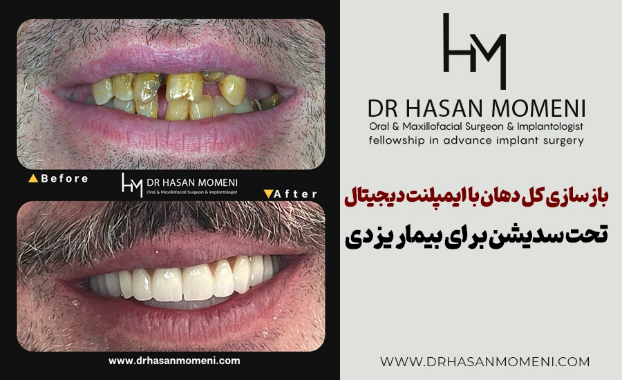 ایمپلنت کل دهان تحت سدیشن برای بیمار از یزد - دکتر حسن مومنی