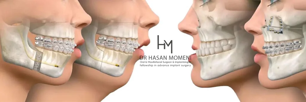 ناهنجاری فک بالا و پایین