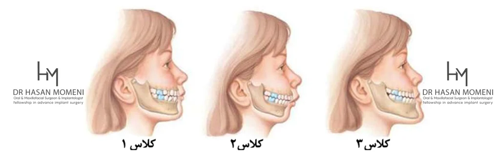 انواع مال اکلوژن و ناهنجاری فک و صورت