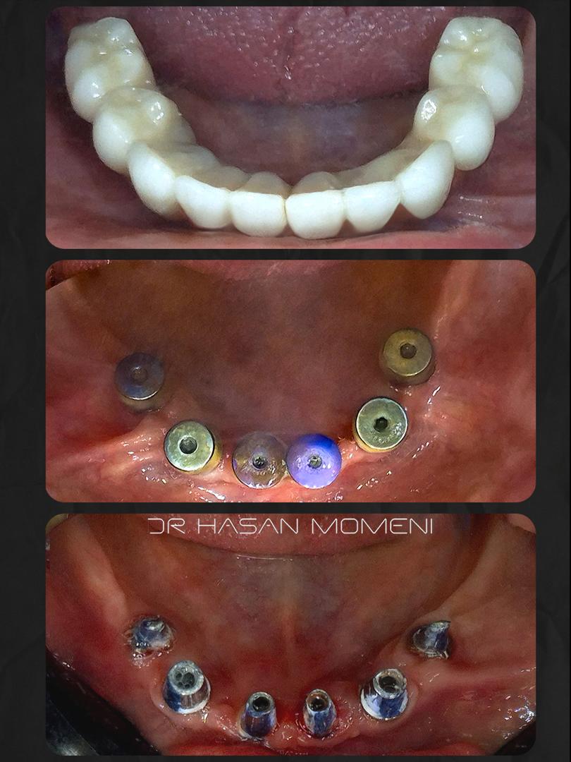 digital-implant-treatment-dr-hasanmomeni140512154_003