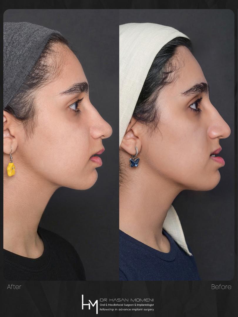 Class-III-Malocclusion-Before-Treatment-dr-hasan-momeni_004