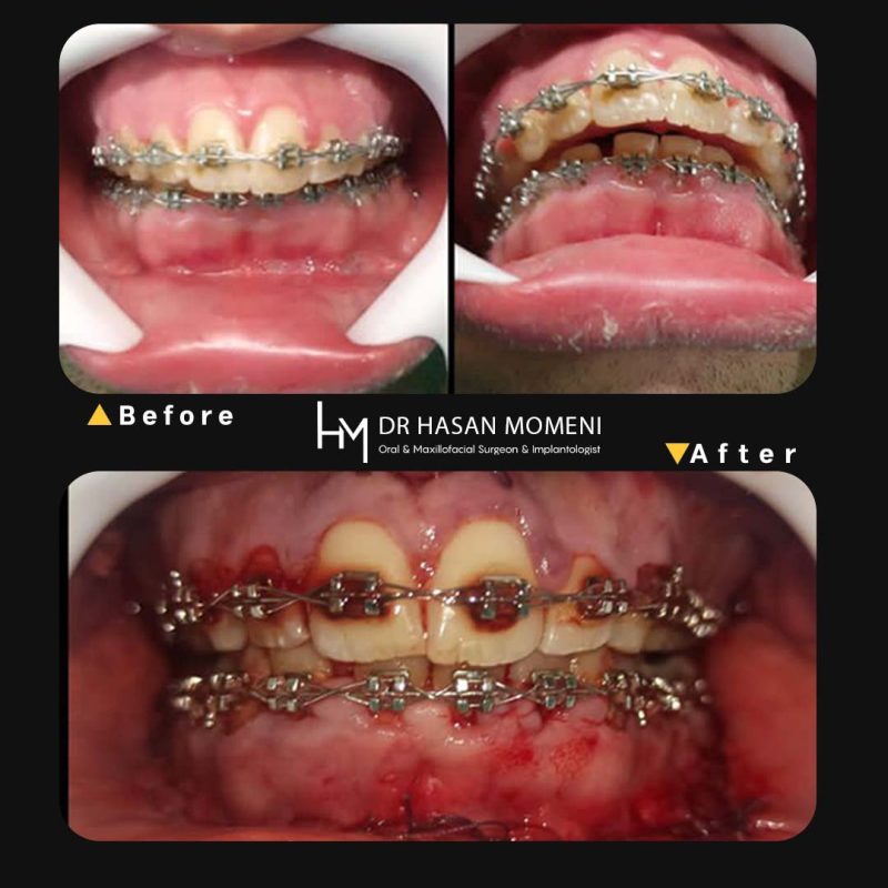 جراحی فک و آماده سازی برای درمان ارتودنسی در اصفهان
