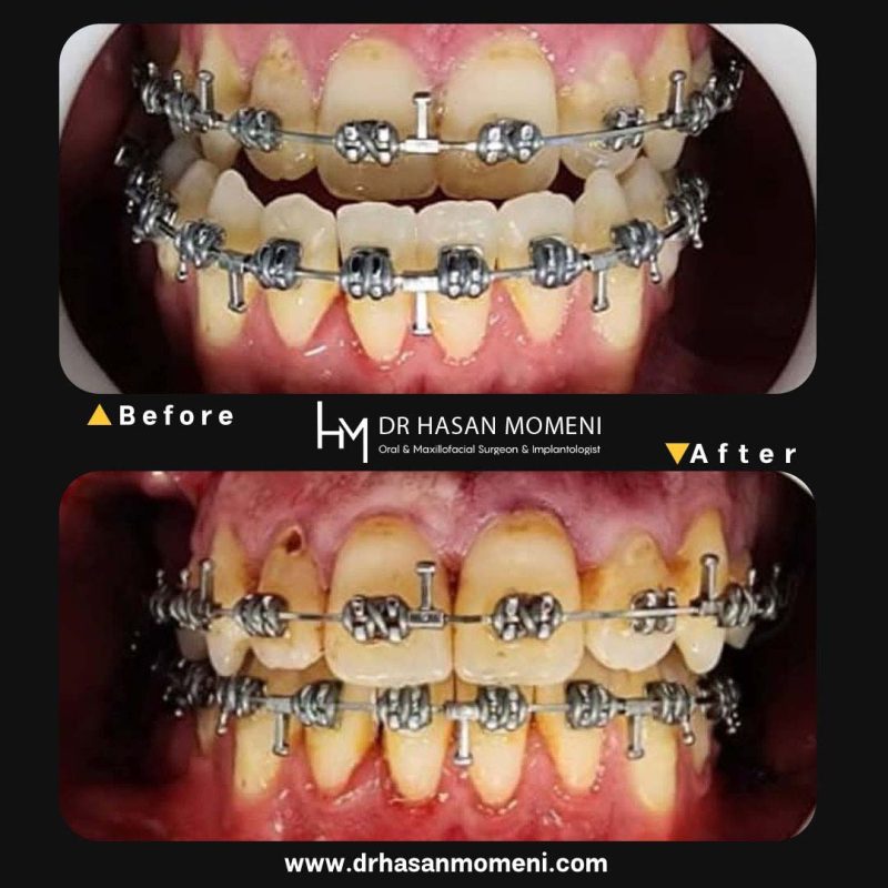 جراحی فک و آماده سازی برای درمان ارتودنسی در اصفهان