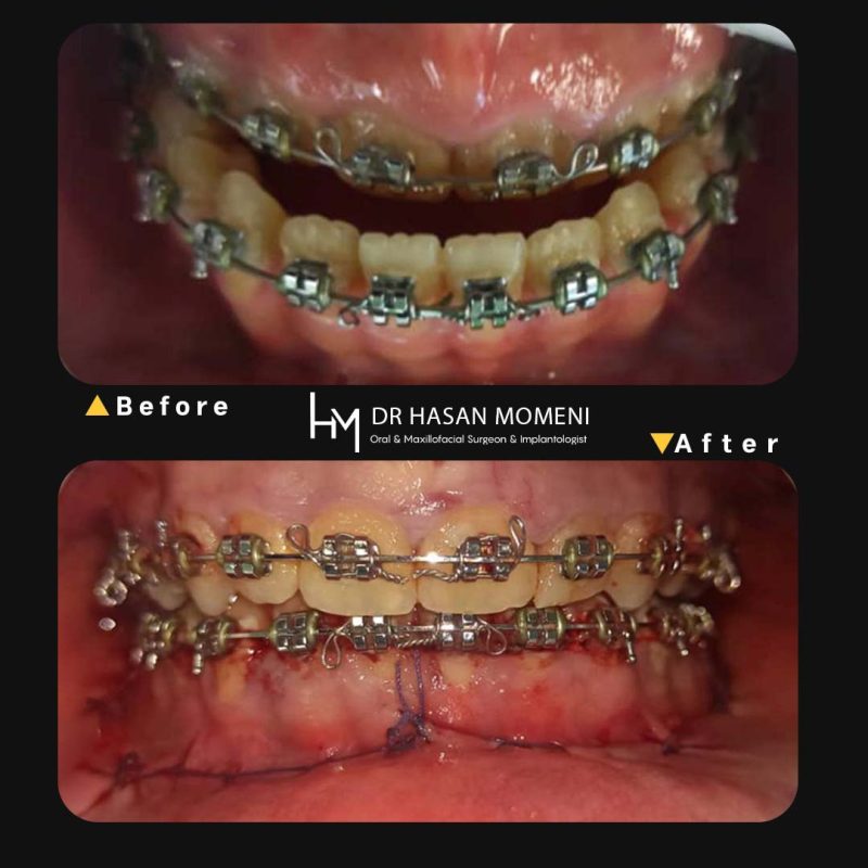 جراحی فک و آماده سازی برای درمان ارتودنسی در اصفهان