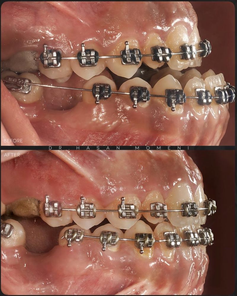 نمونه قبل و بعد جراحی فک در اصفهان دکتر حسن مومنی